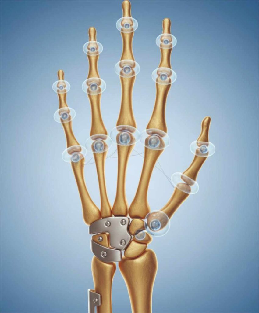 HandUpper Extremity ICONE