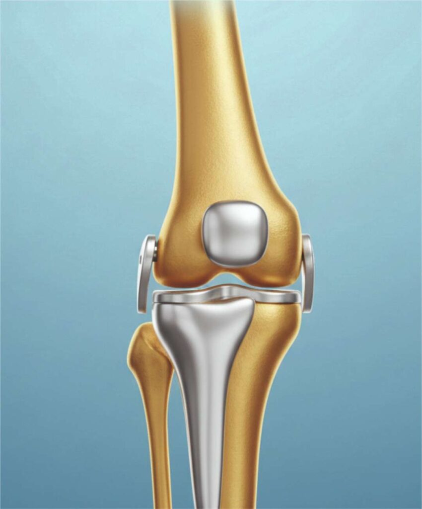 KNEE-REPLACEMENT-ICON