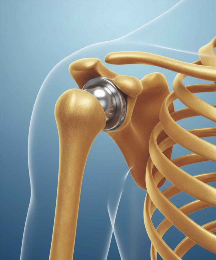 Shoulder Replacement ICON