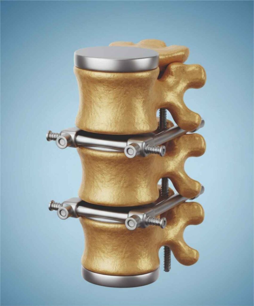 Spine Surgery ICON