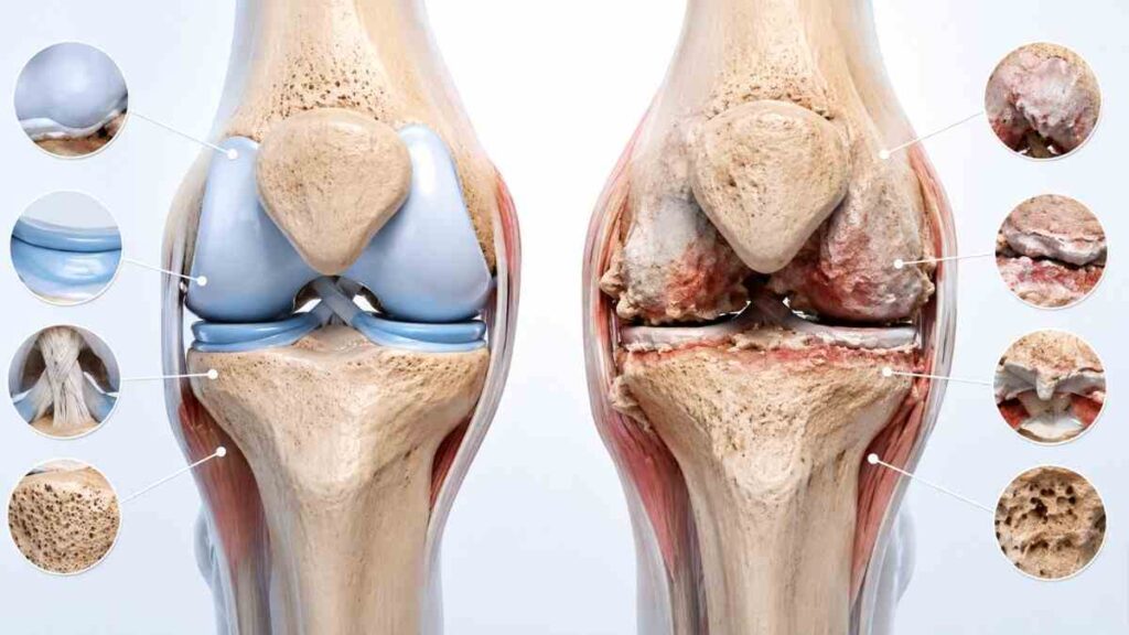 Healthy knee joint compared with osteoarthritis affected knee